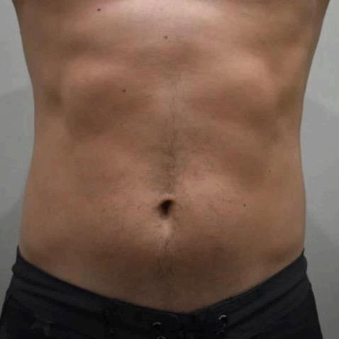 Accufit Laser AFTER