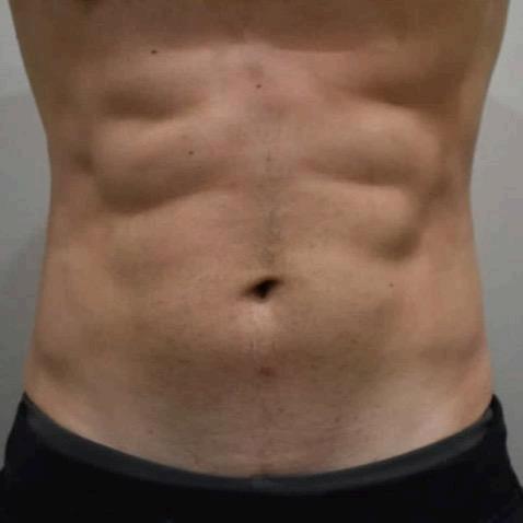 Accufit Laser BEFORE